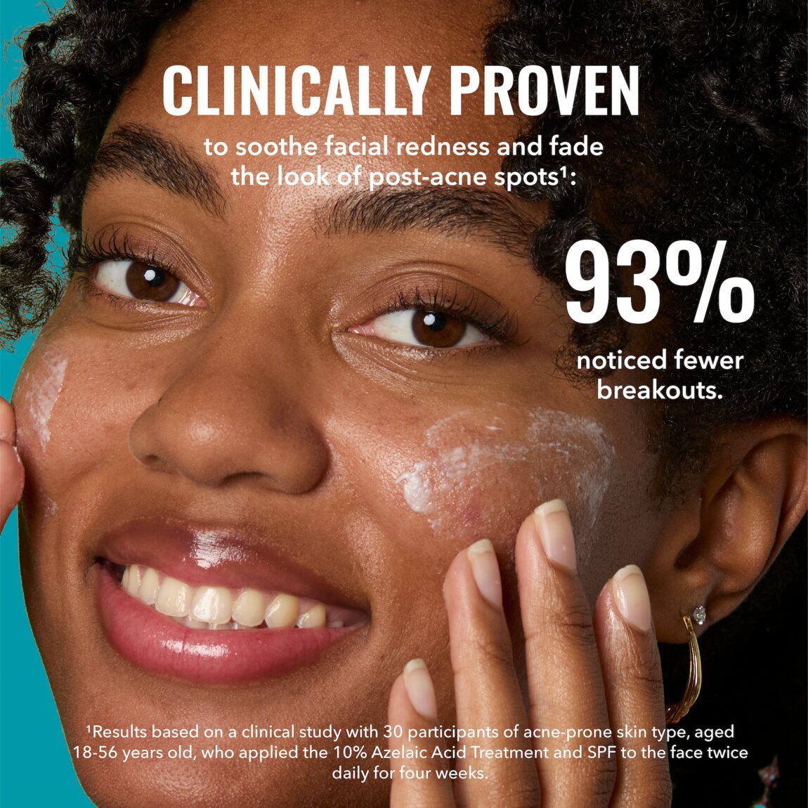 10-azelaic-acid-treatment-r9 zb_p.jpg