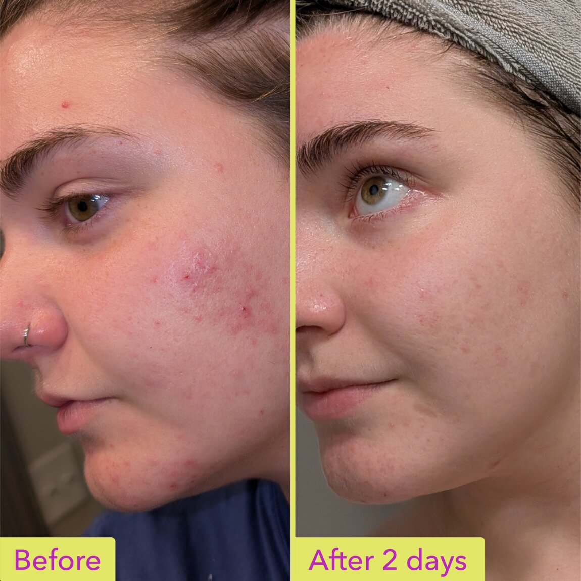 10-azelaic-acid-treatment-r9 zb_p.jpg