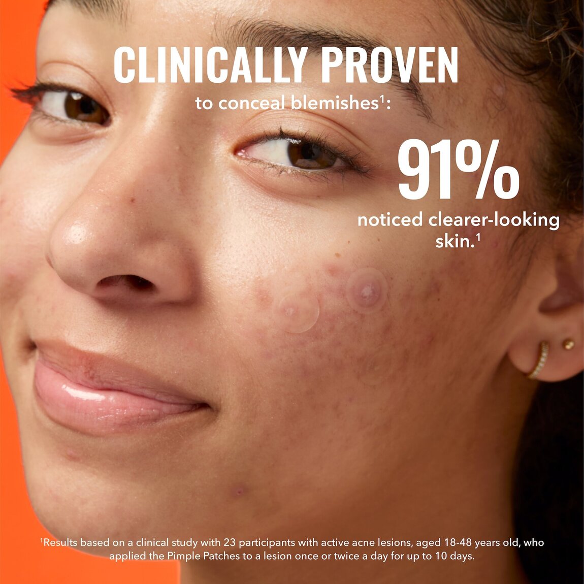 pimple-patches-f9 zb_p.jpg